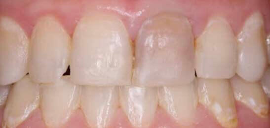 Композитные реставрации передних зубов