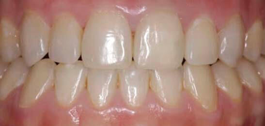 Композитные реставрации передних зубов недорого