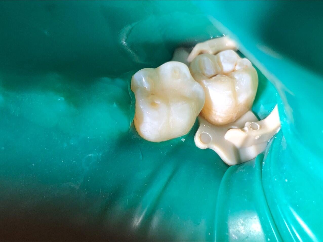 Композитная реставрация зуба недорого