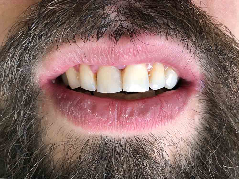 Реставрация переднего зуба композитом недорого