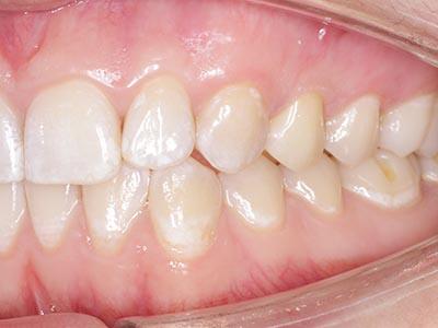 Лечение каналов зуба и установка циркониевой<br>коронки недорого