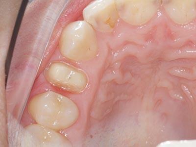 Лечение каналов зуба и установка циркониевой<br>коронки недорого