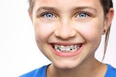 Детские пластинки для выравнивания зубов